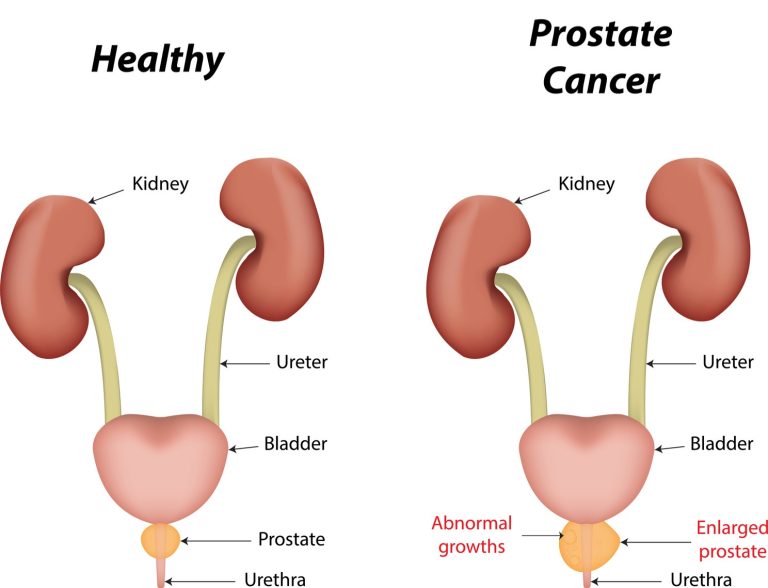 تأثير سرطان البروستاتا على الصحة الجنسية: التحديات والحلول