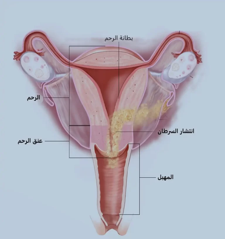 تجنب سرطان عنق الرحم