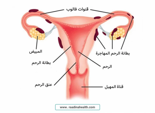 بطانة الرحم المهاجرة: الأسباب، الأعراض، والعلاج