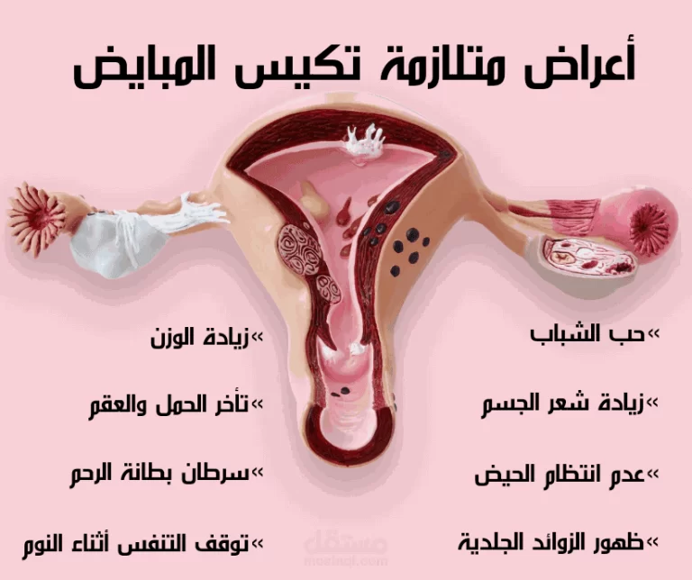 تكيس المبايض: الأسباب والأعراض والعلاج